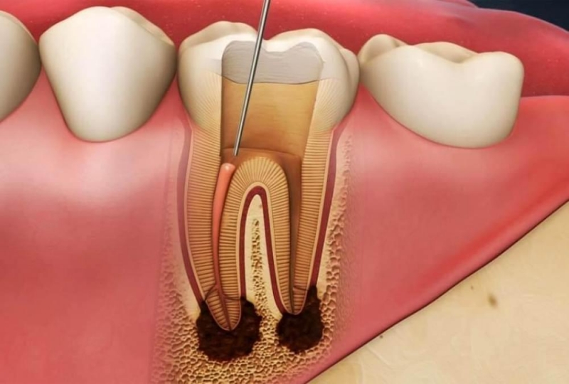 Endodontik Tedaviler